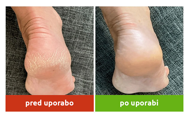 Vlažilne nogavice Heel - pred in po uporabi Vlažilne nogavice Heel - pred in po uporabi